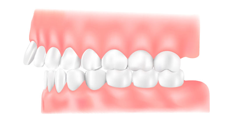 上顎前突（じょうがくぜんとつ）