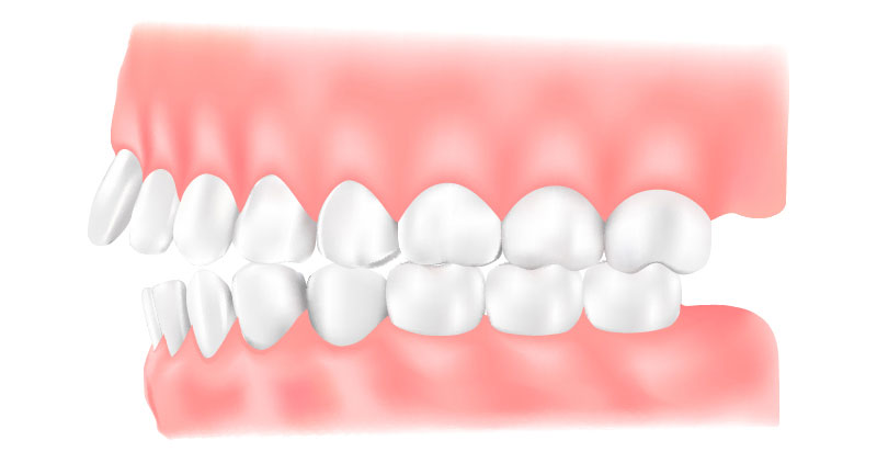 上下顎前突（じょうかがくぜんとつ）