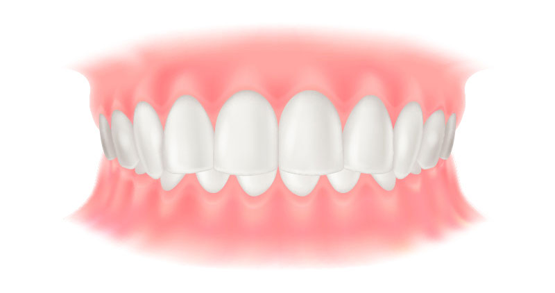 過蓋咬合（かがいこうごう）