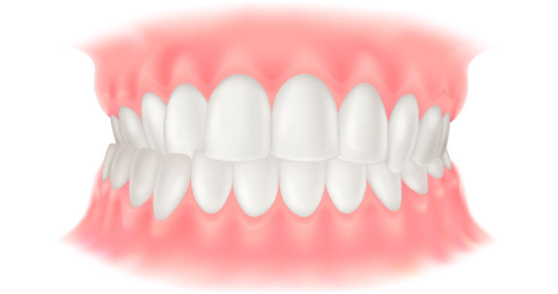 交叉咬合（こうさこうごう）