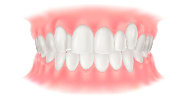 叢生（そうせい）（八重歯）