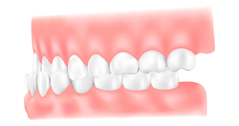 下顎前突（かがくぜんとつ）