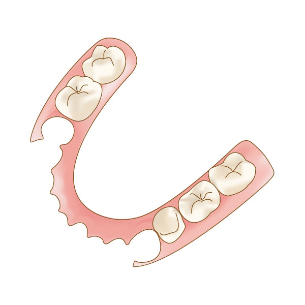 ノンクラスプデンチャー