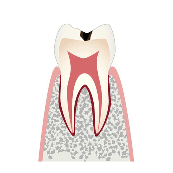 エナメル質に小さな穴が空いた虫歯