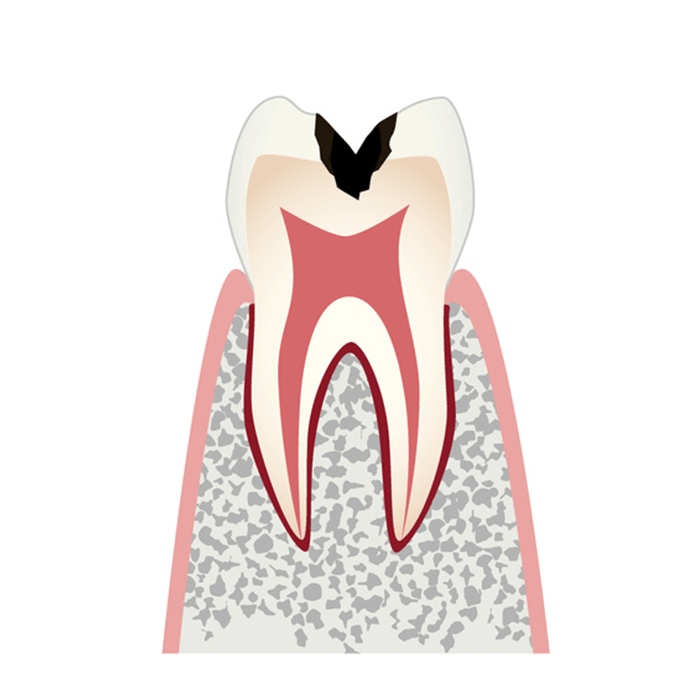 歯の内部(象牙質)まで進行した虫歯