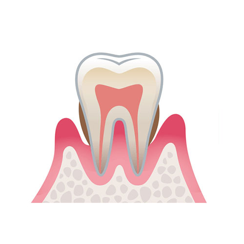 中度歯周病