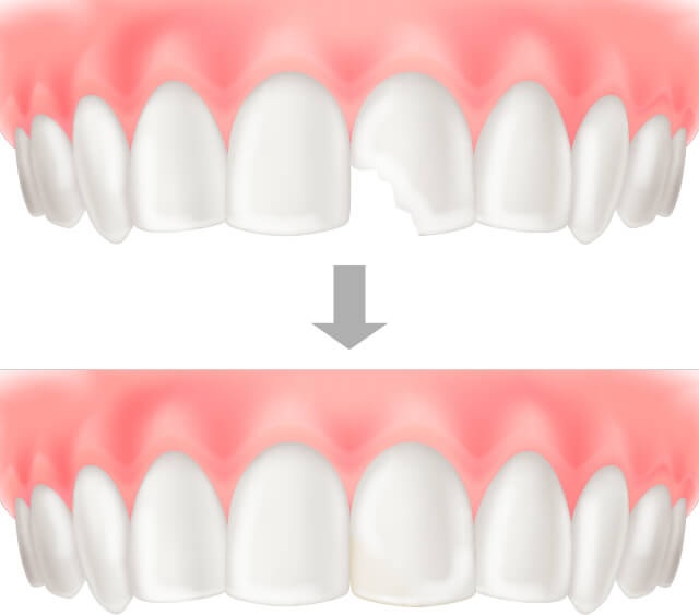 ダイレクトボンディング(コンポジットレジン)
